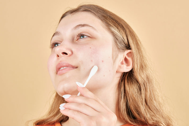 Stress Acne and A Simple Skincare Guide That Works